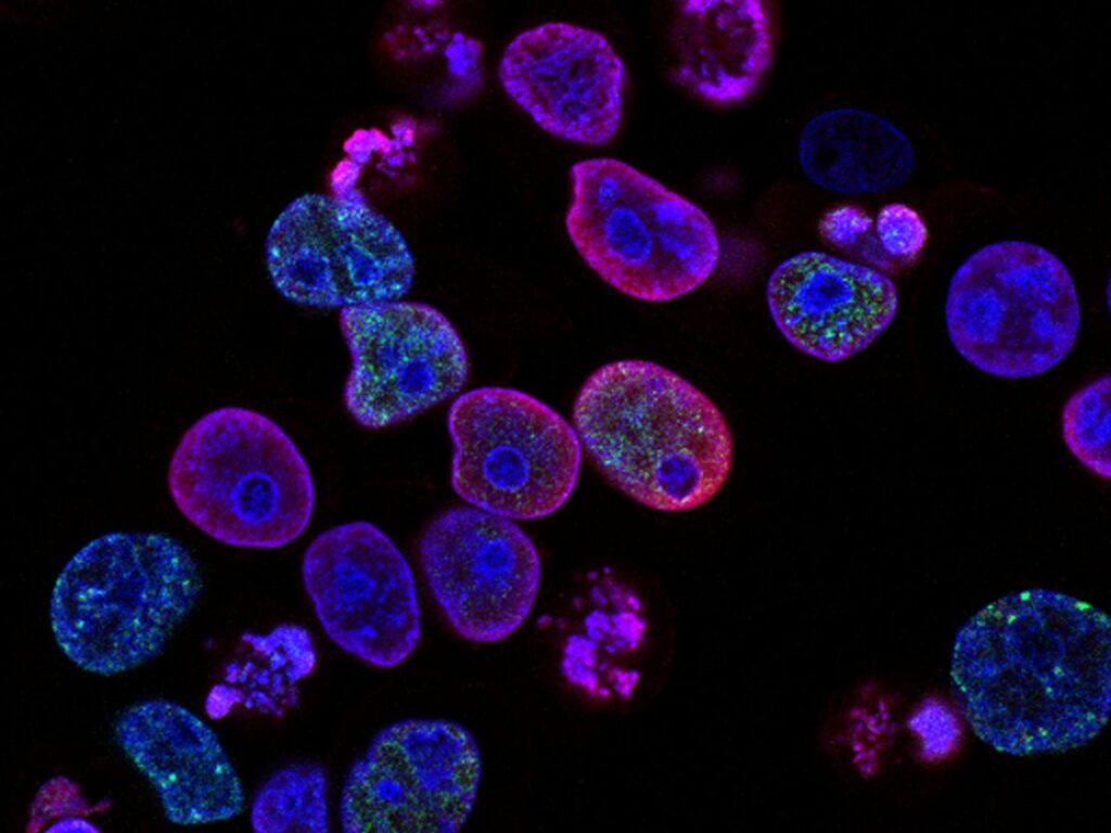 Le modèle PRISM2 utilise le dialogue clinique pour interpréter les diapositives de pathologie